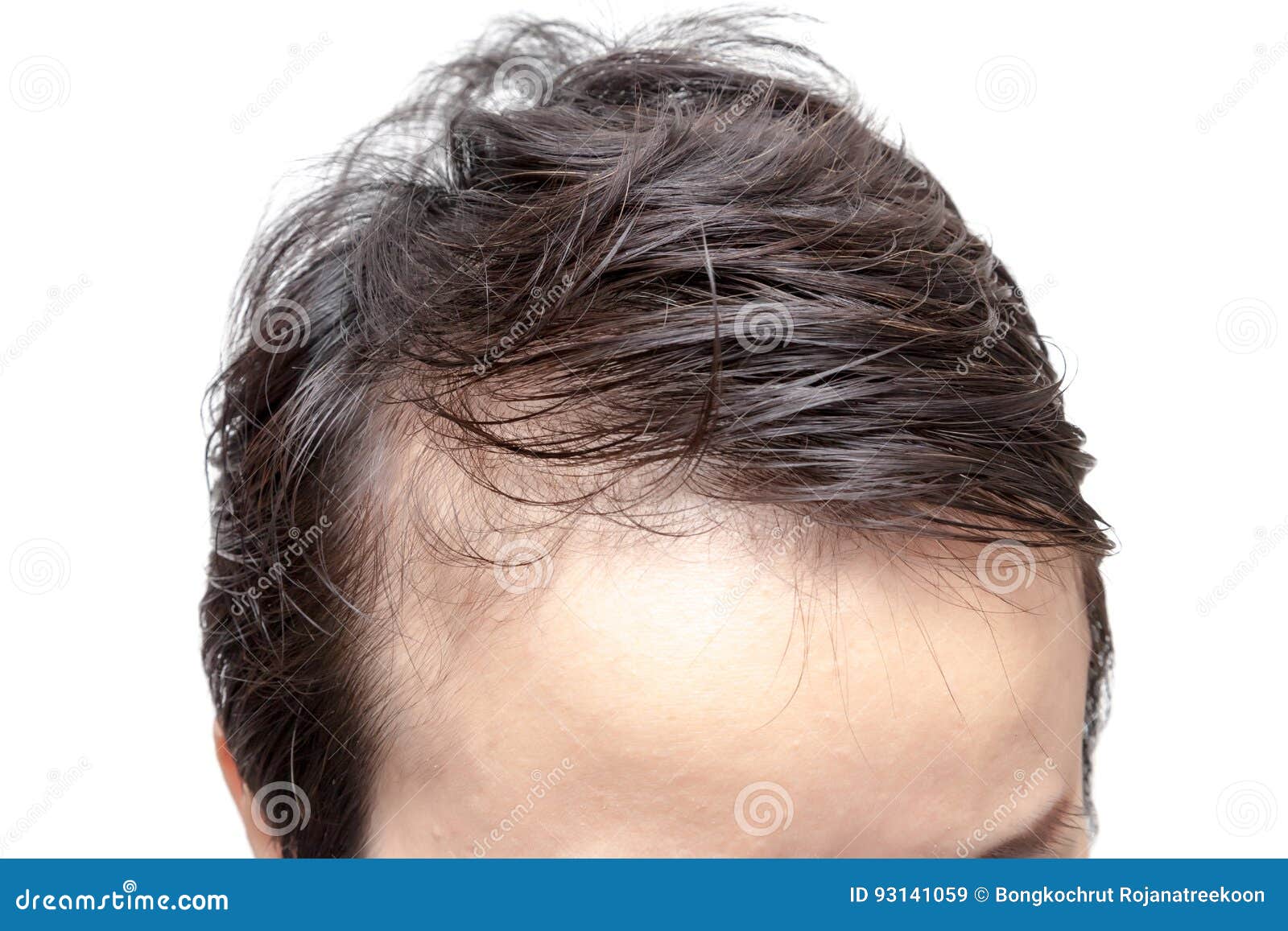 bald man or woman worry about his or her less hairline
