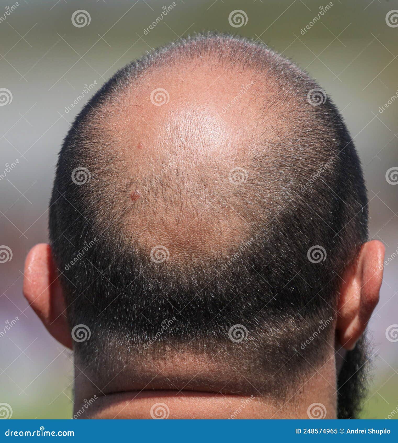Bald Patch on the Head of a Man. Stock Image Image of closeup, male