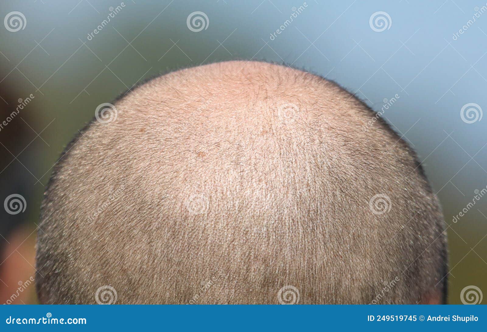 Bald Patch on the Head of a Man. Stock Image Image of male, care