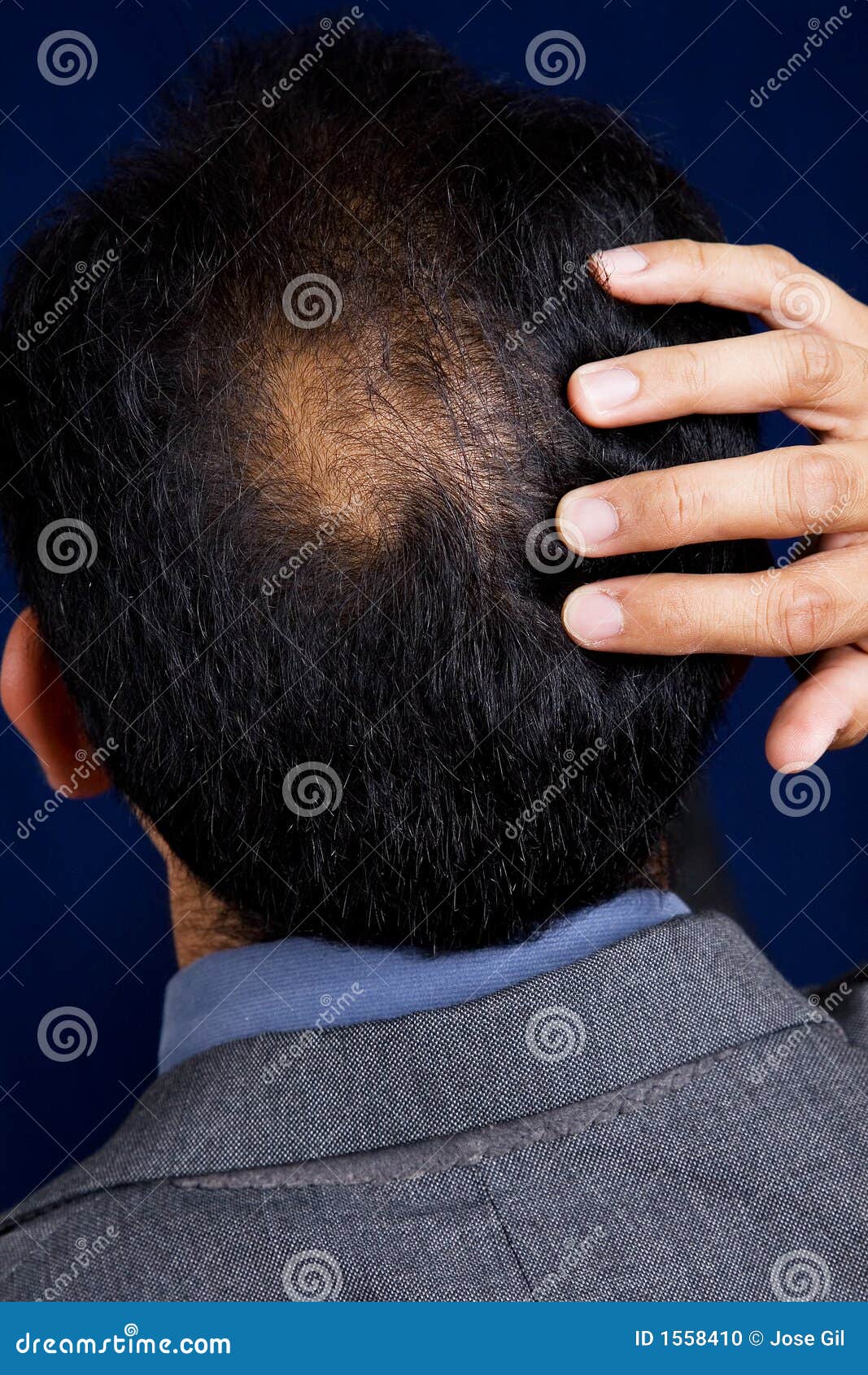 Bald Spot Stock Photo Image Of Dark Suit Spot Hairless 1558410