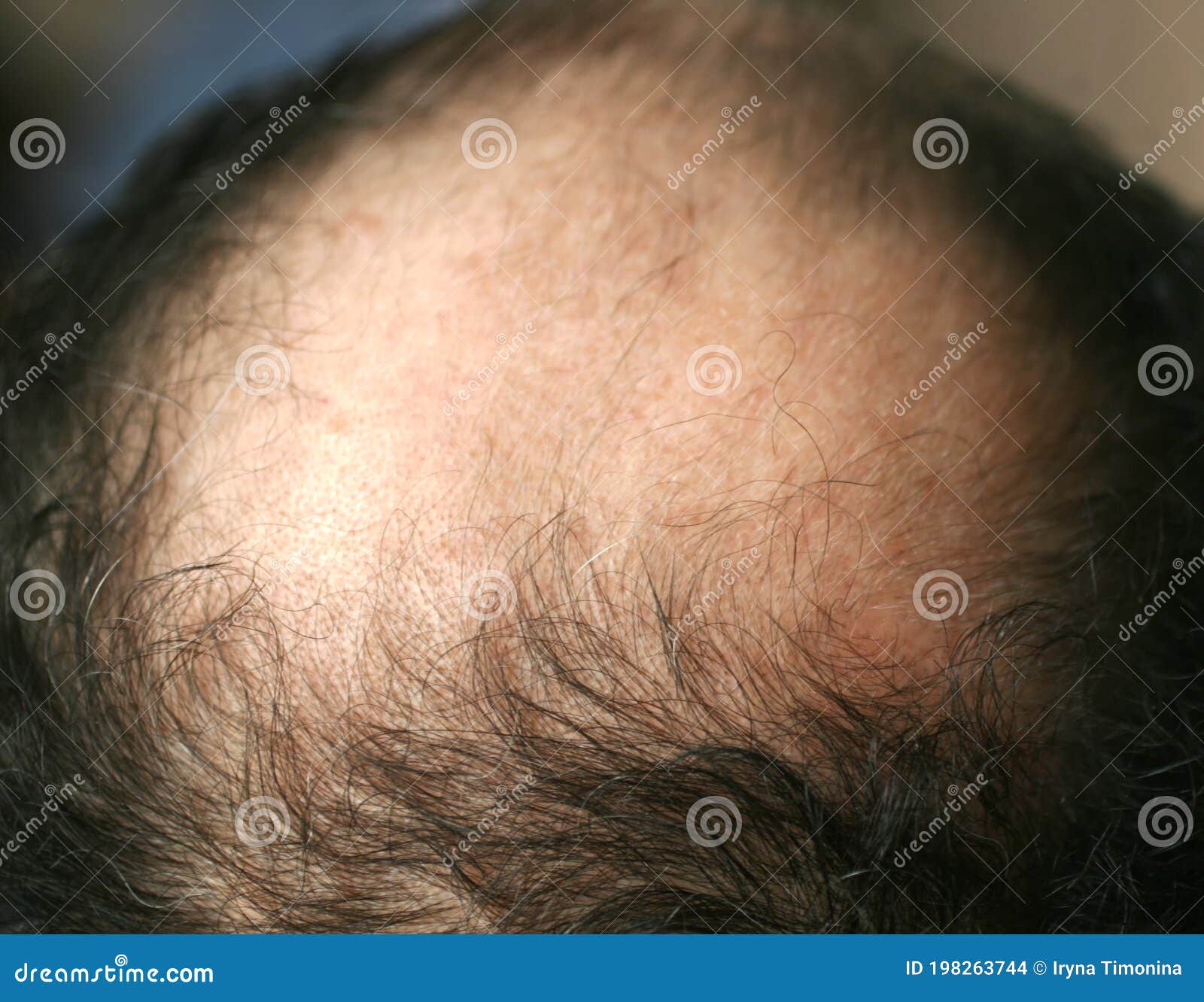 Circular Hair Loss Stock Photos - Free & Royalty-Free Stock Photos from  Dreamstime