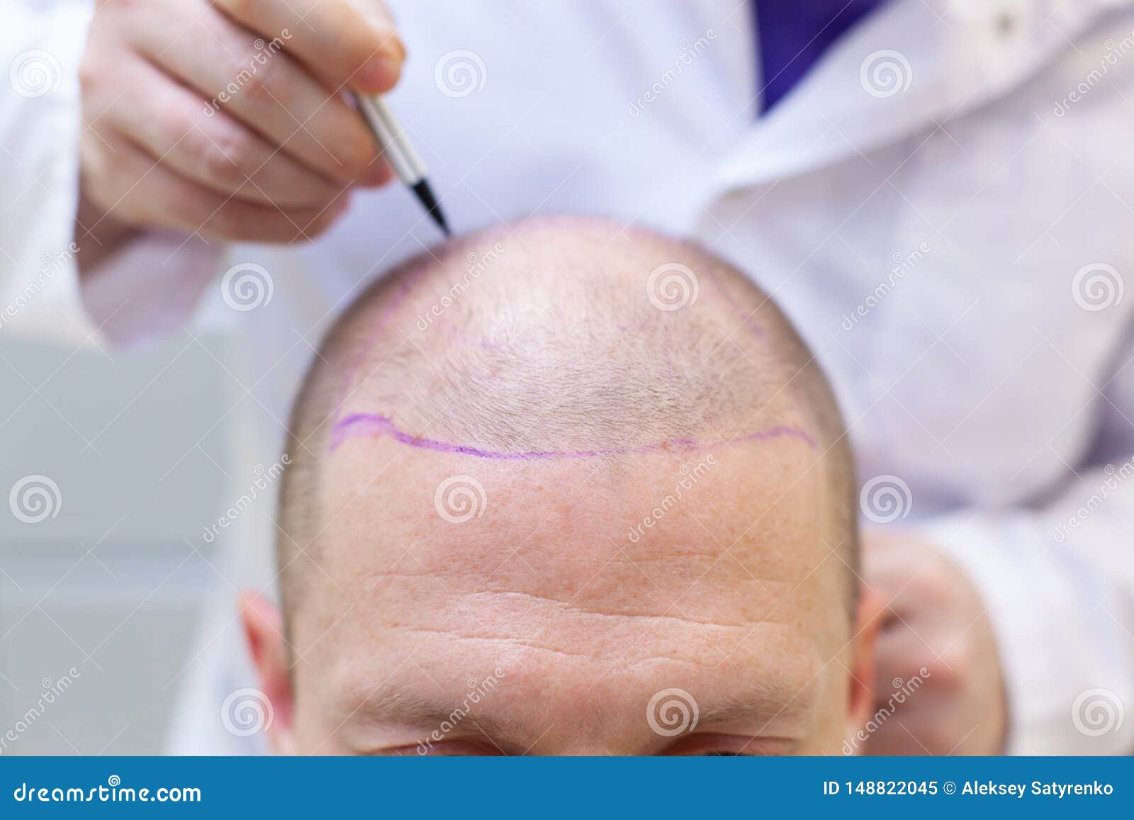 baldness treatment. patient suffering from hair loss in consultation with a doctor. preparation for hair transplant