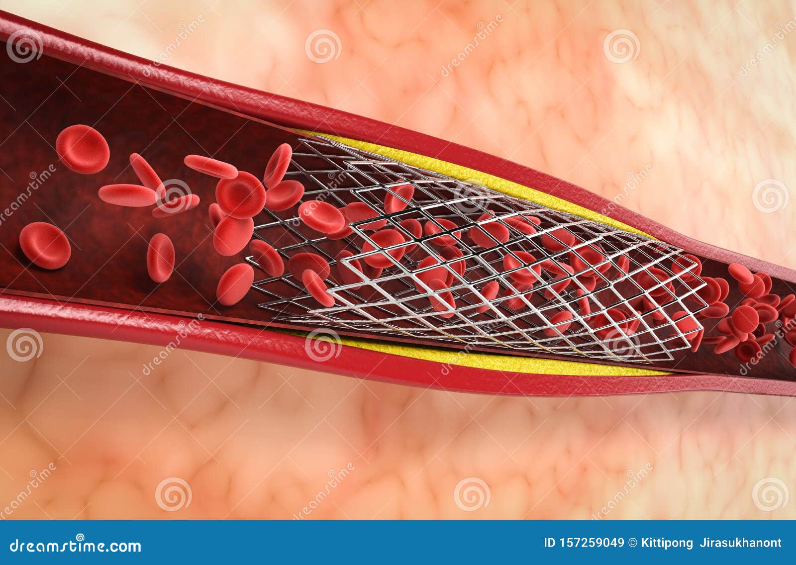 Balloon Angioplasty Procedure Stock Illustration - Illustration of brain, flow: 157259049 Balloon Angioplasty Procedure Stock Illustration - Illustration of brain, flow: 157259049