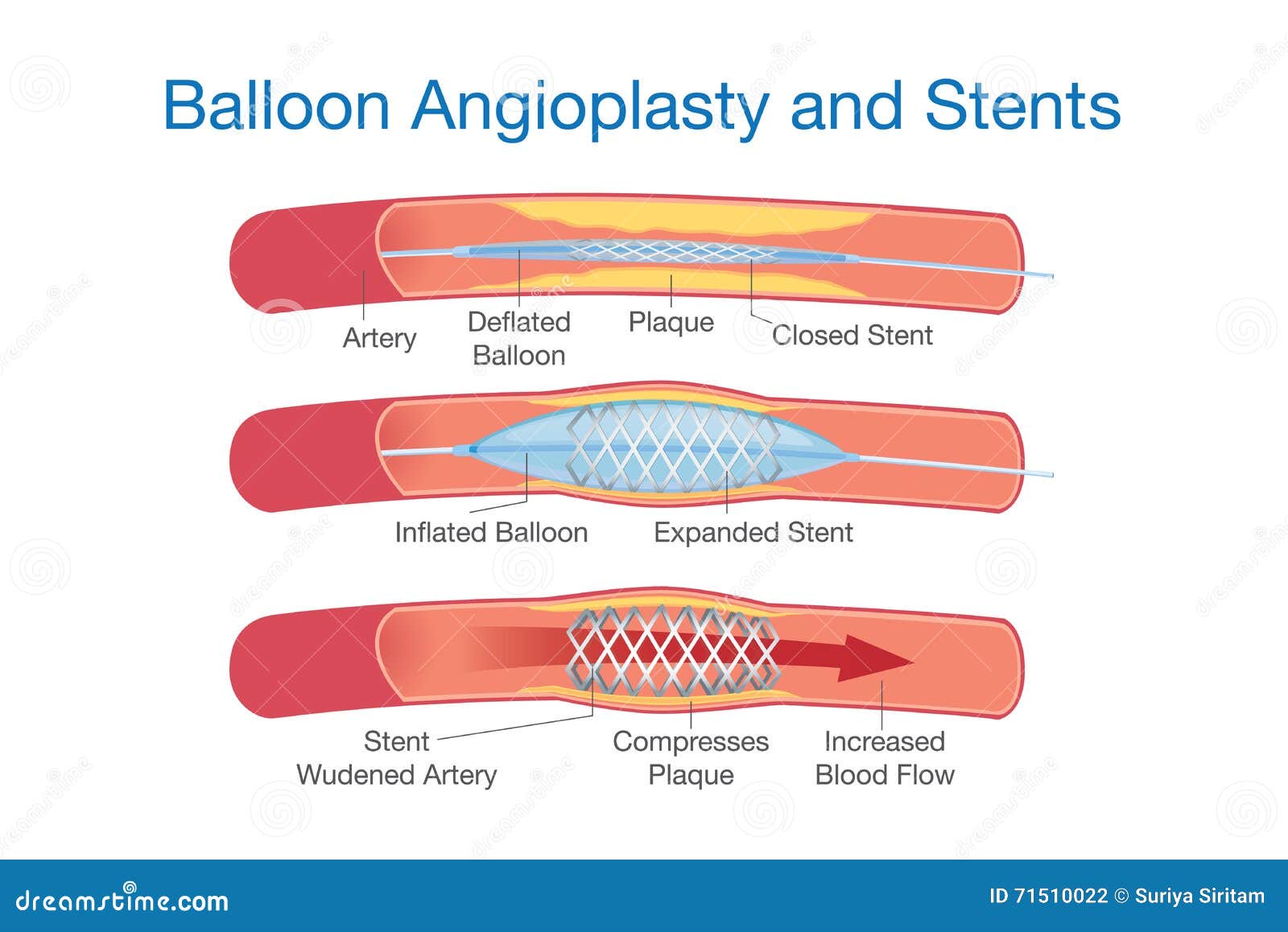 balloon angioplasty and stents procedure