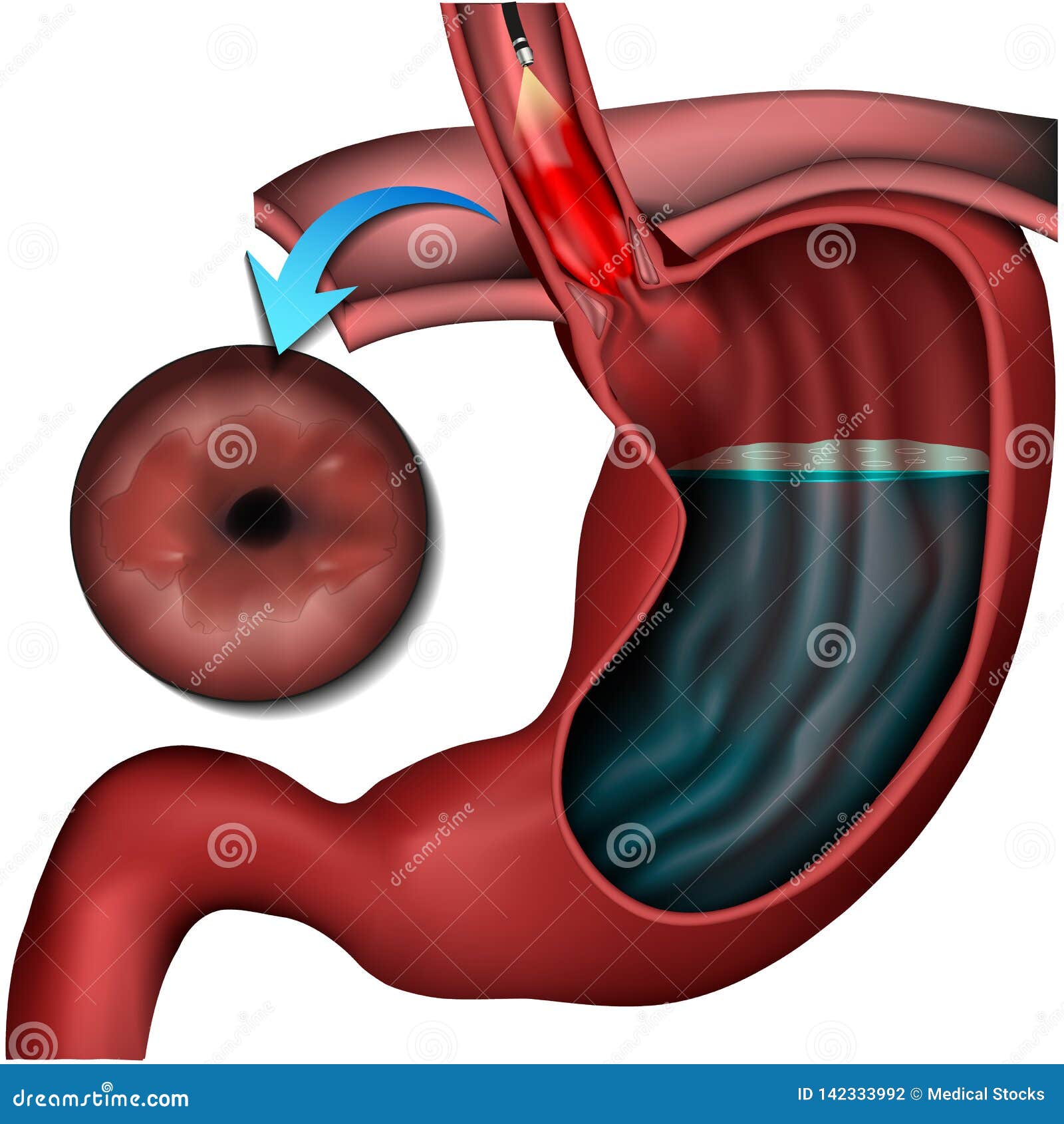 barett esophagus disease medical   on white background