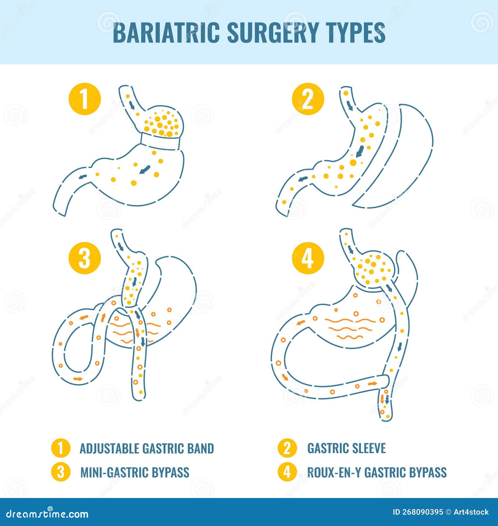bariatric surgery weight loss procedure types infographics