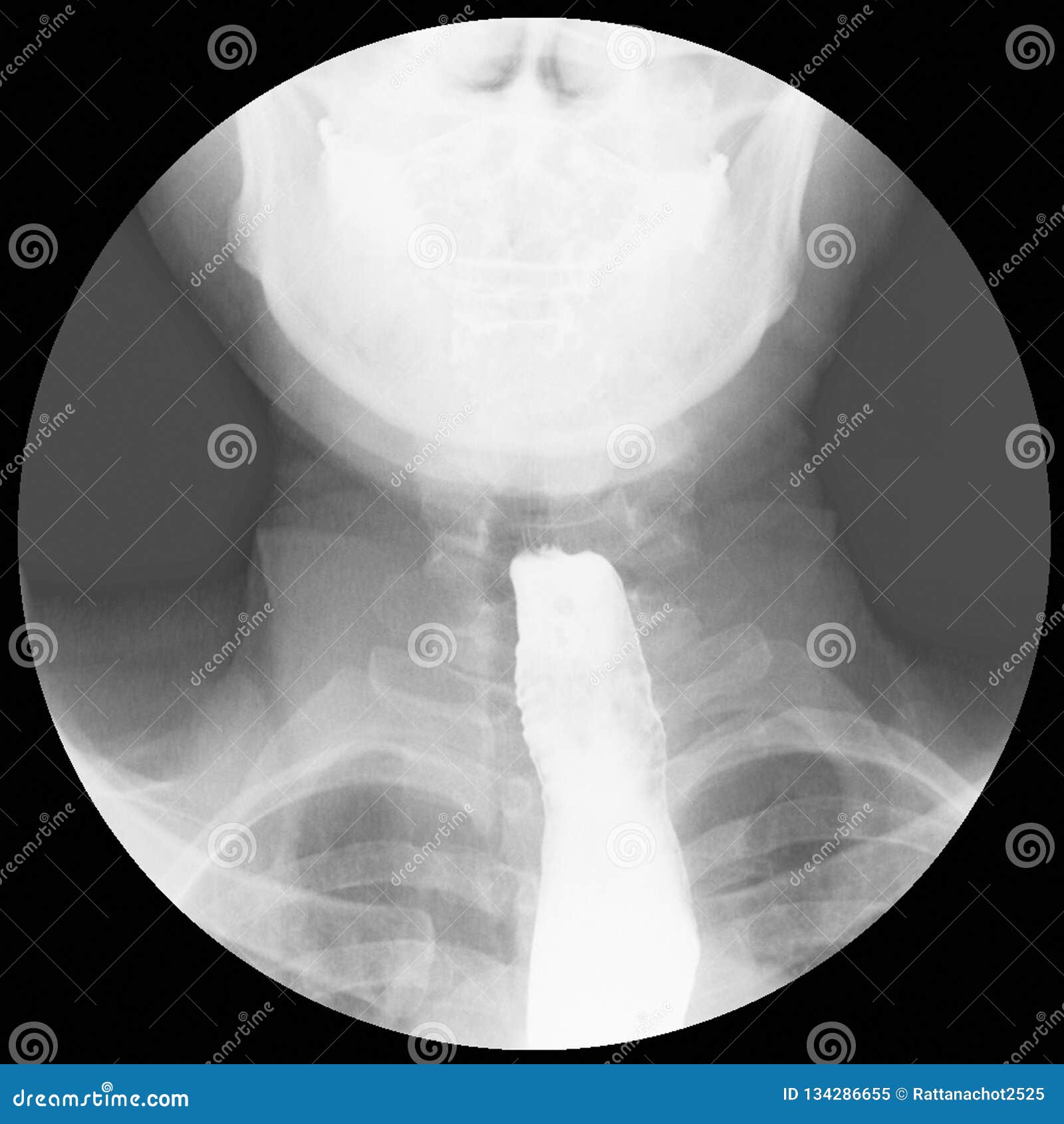 barium swallow evidence of achalasia at distal esophagus to eg junction.moderate proximal dialtation of esophagus with