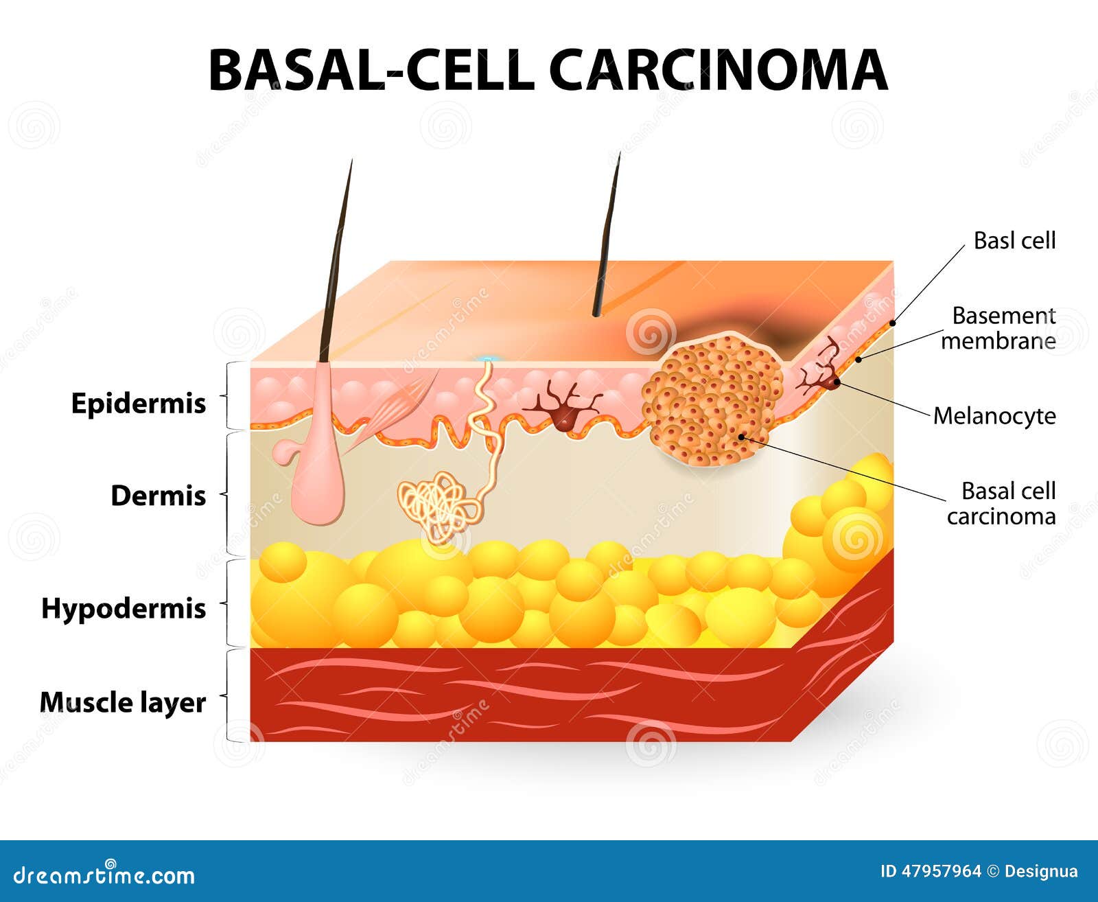 Распад кожи. Кожные новообразования базалиома. Базально-клеточная карцнома. Базальноклеточная карцинома кожи. Опухоль базального слоя кожи.