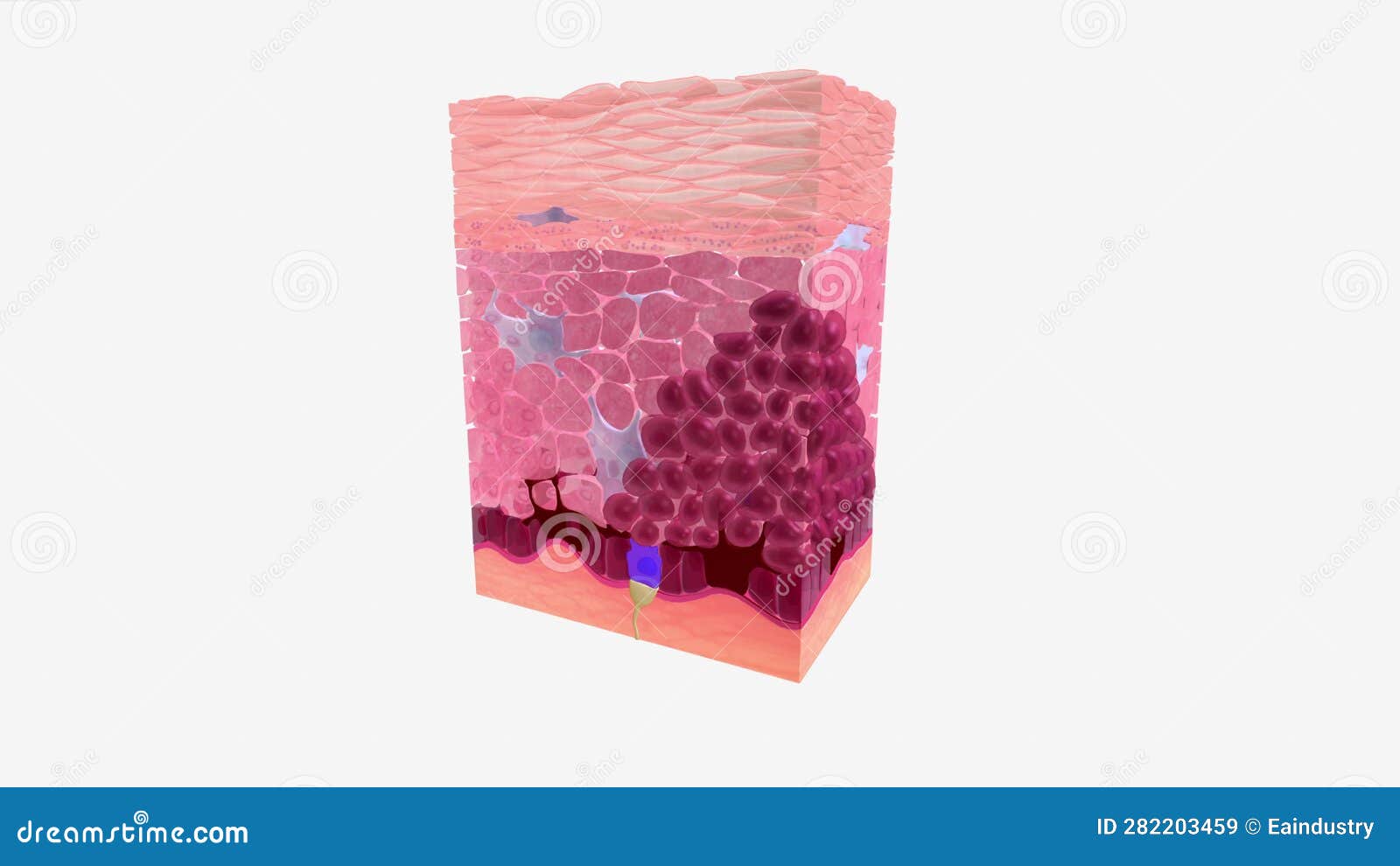 Basal Cell Carcinoma in Tissue Stage 0 Stock Video Video of sebaceous