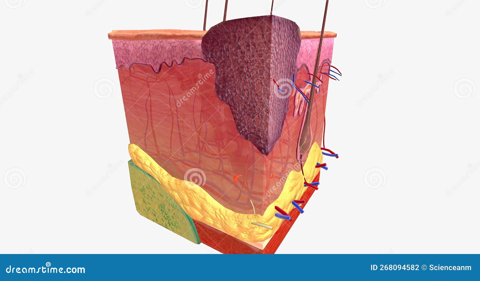 Basal Cell Carcinoma in Tissue, Stage 1 Stock Illustration