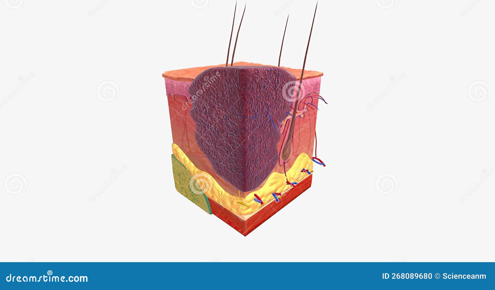 Basal Cell Carcinoma in Tissue, Stage II Stock Illustration