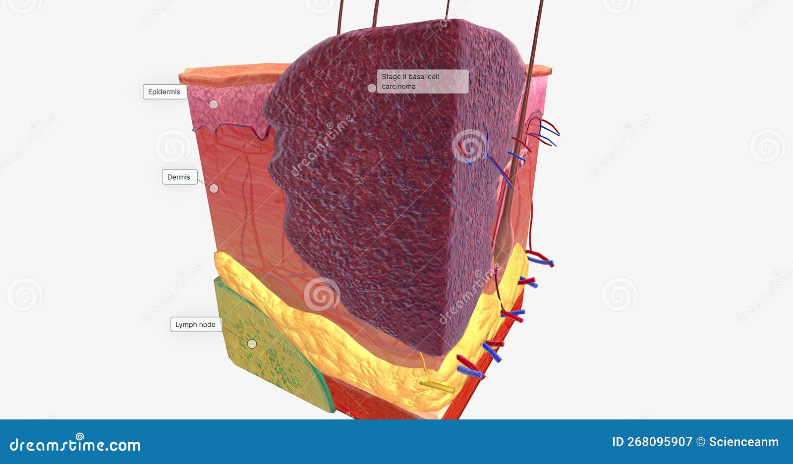 Basal Cell Carcinoma in Tissue, Stage II Stock Illustration Illustration of cell, carcinoma