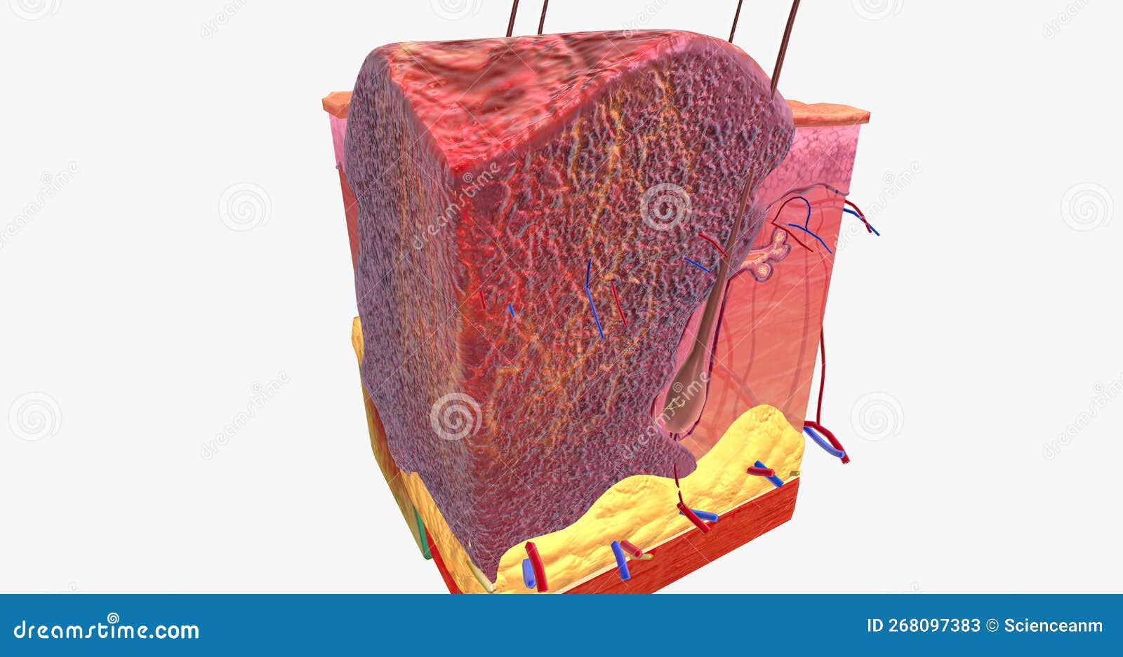 Basal Cell Carcinoma in Tissue, Stage III Stock Image Image of tissue, morphological 268097383
