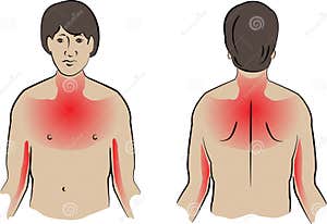 Heart Attack Pain Locations Medical Illustration Stock Illustration 