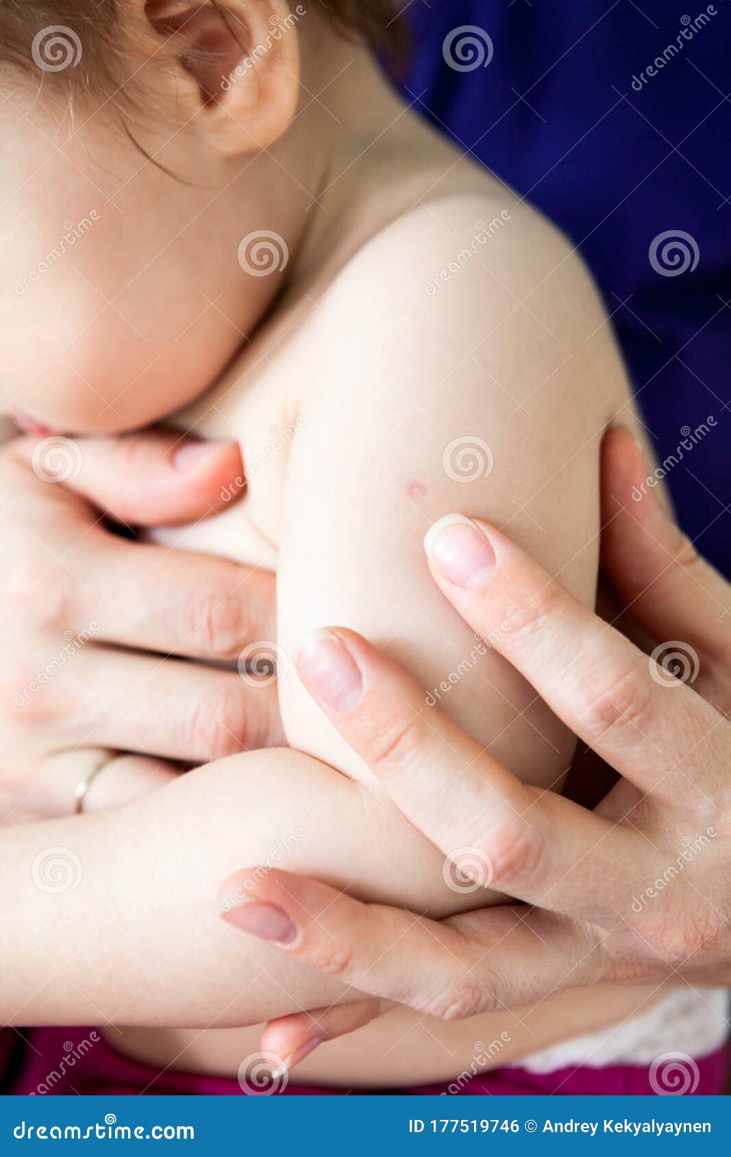 Vaccine Scar Photos Free Royalty Free Stock Photos From Dreamstime