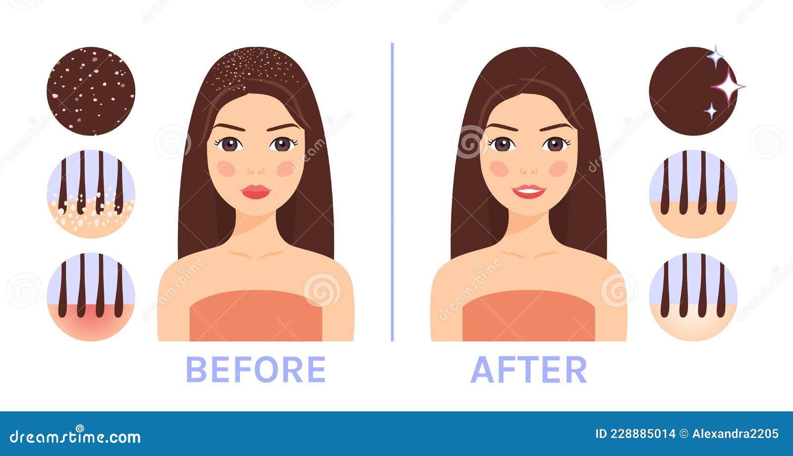 Beautiful Brunette Woman with Dandruff on Hair. Treatment of Scalp. before  and after. Seborrhea Icons Stock Vector - Illustration of allergy,  sensitive: 228885014