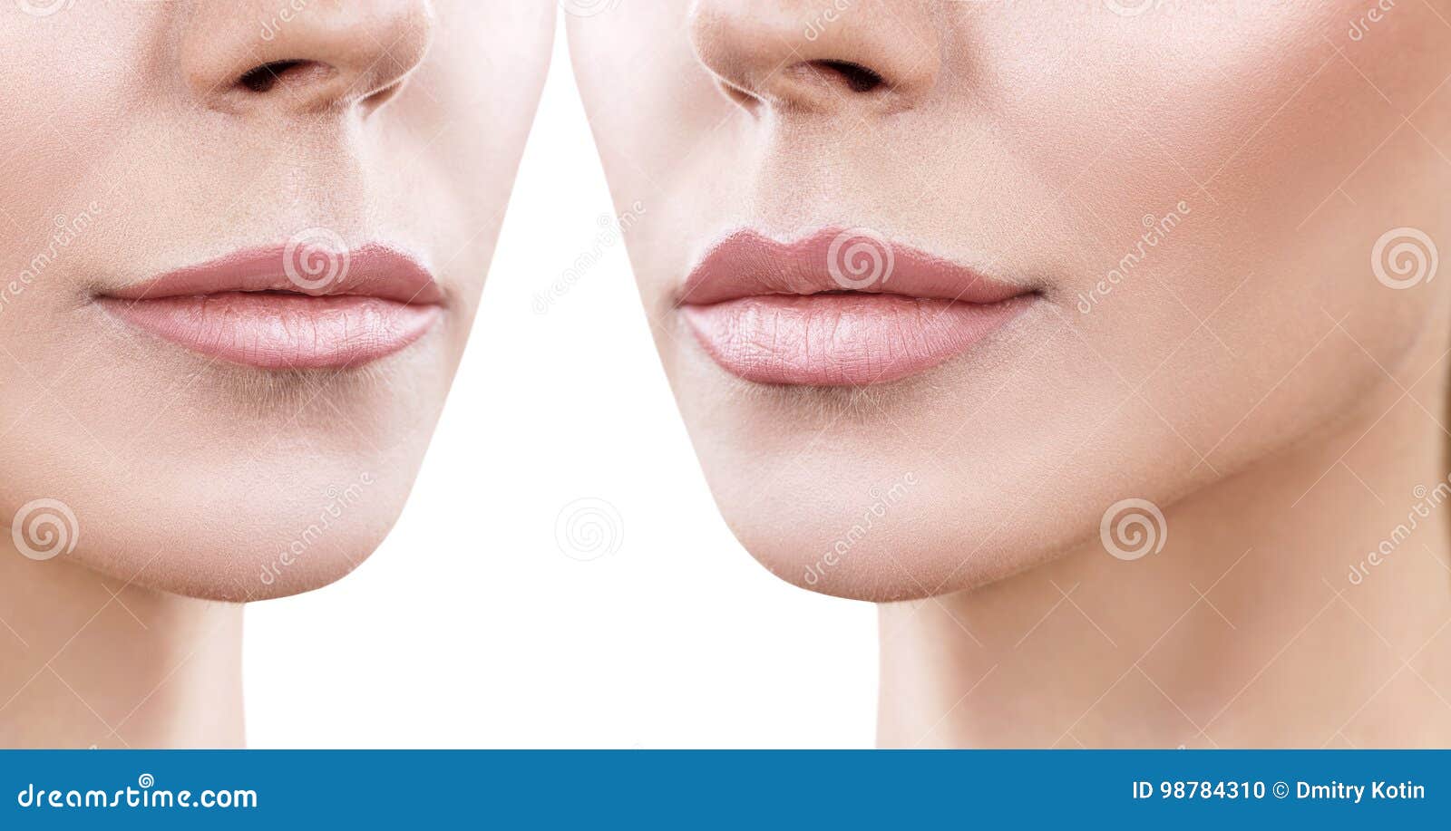 lips of adult woman before and after augmentation