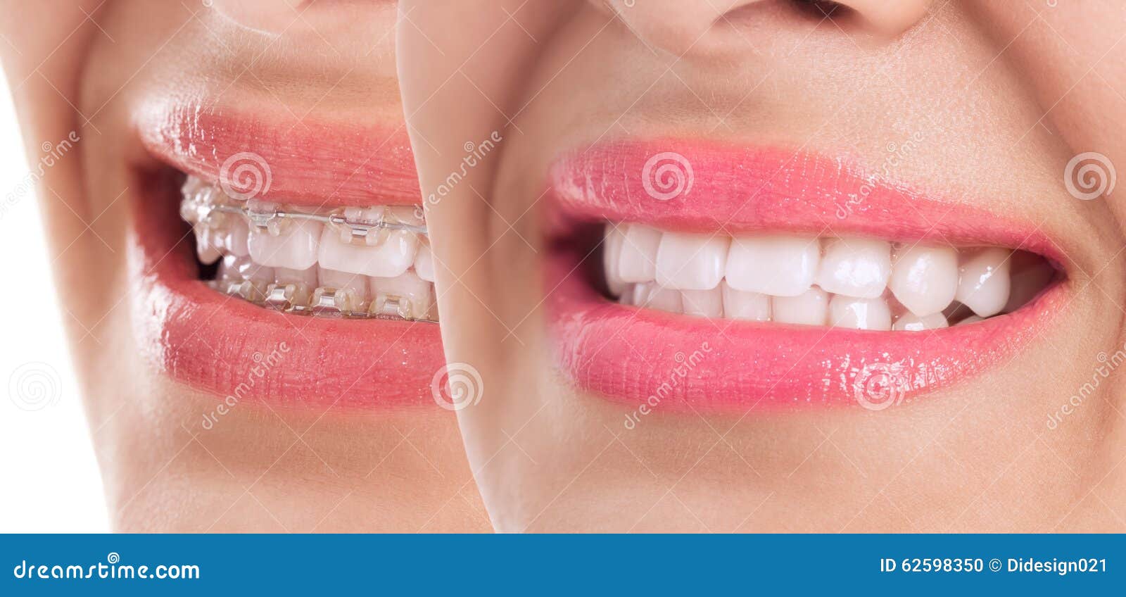 Beautiful Teeth After Braces Treatment Stock Photo Image 62598350