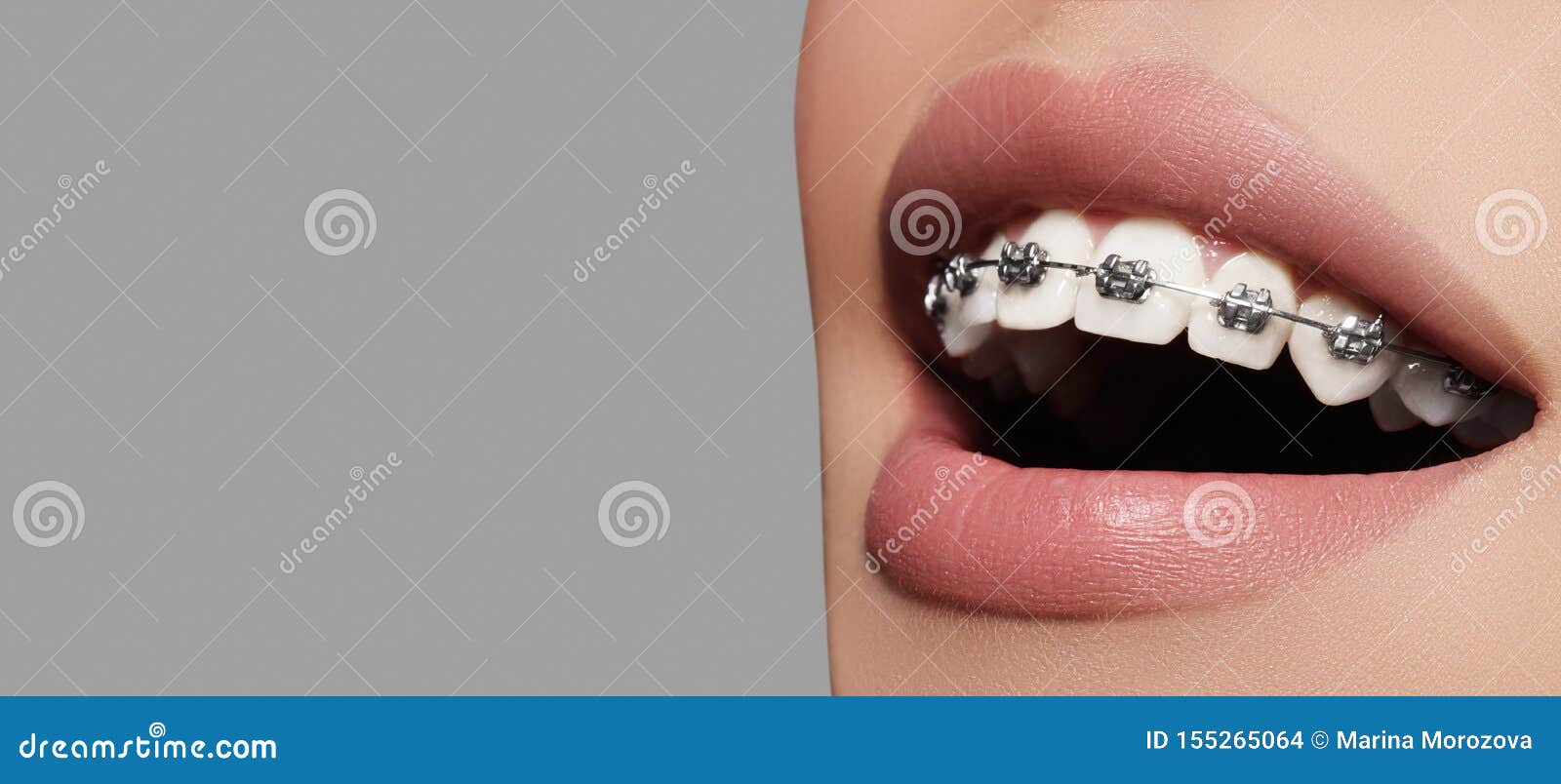 beautiful white teeth with braces. dental care photo. woman smile with ortodontic accessories. orthodontics treatment