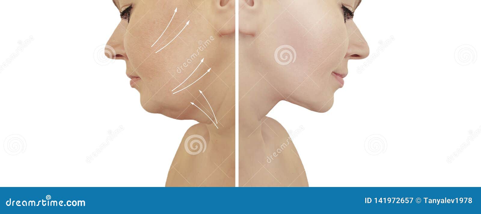 beautiful woman double chin lift before and after correction liposuction procedures