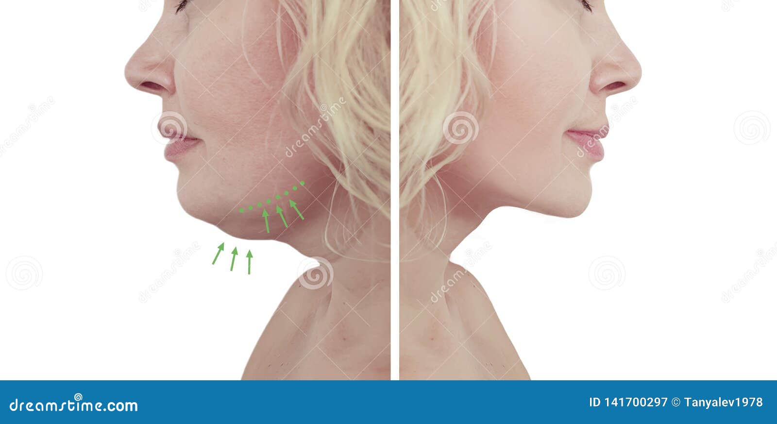 beautiful woman double chin collage before and after liposuction procedures