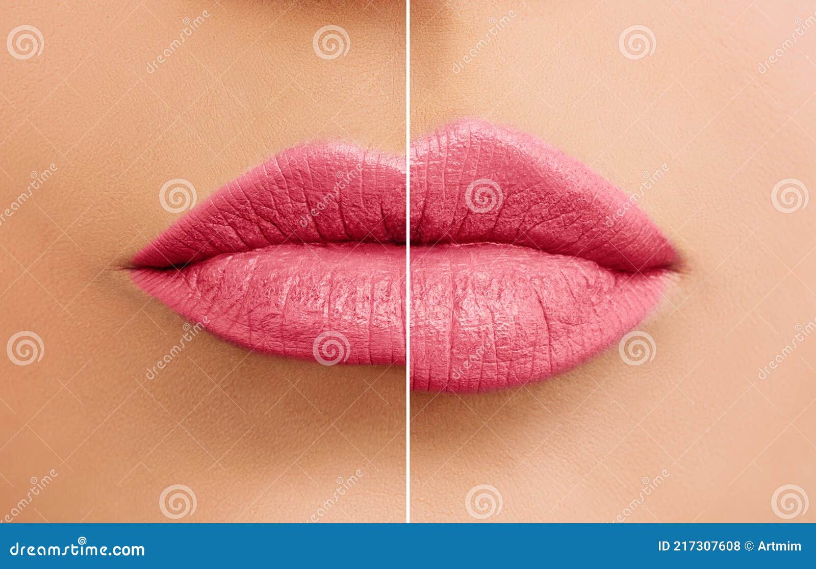 beautiful woman lips before and after lip filler injections close up
