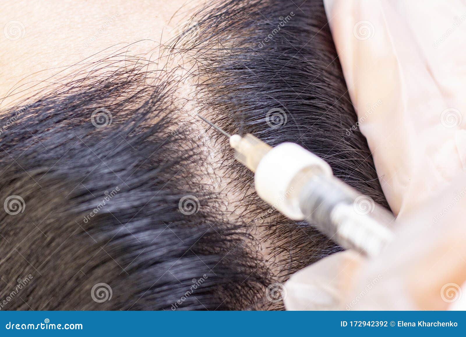 Beauty Clinic they Inject with a Syringe in the Black Roots of the Hair for  Regeneration. Stimulating Hair Growth Stock Photo - Image of fall, closeup:  172942392