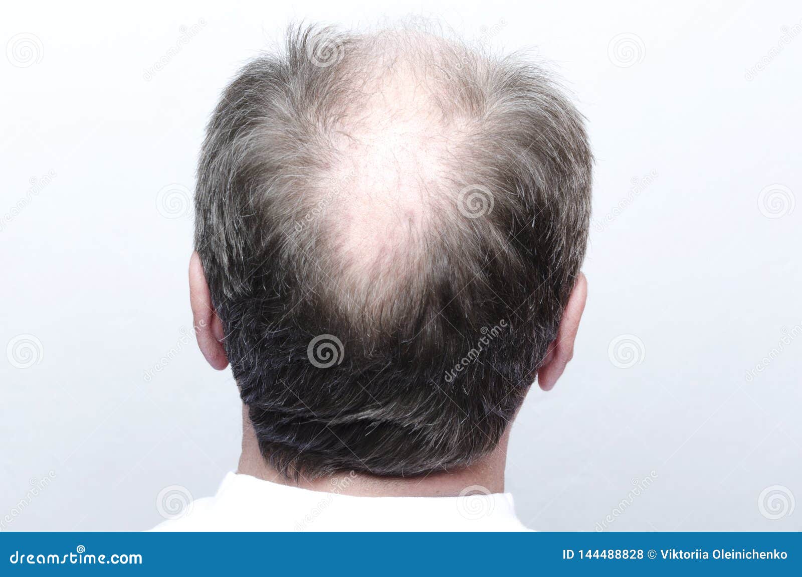 Back of Male Bald  of Baldness Stock Photo - Image of bottle,  baldness: 144488828