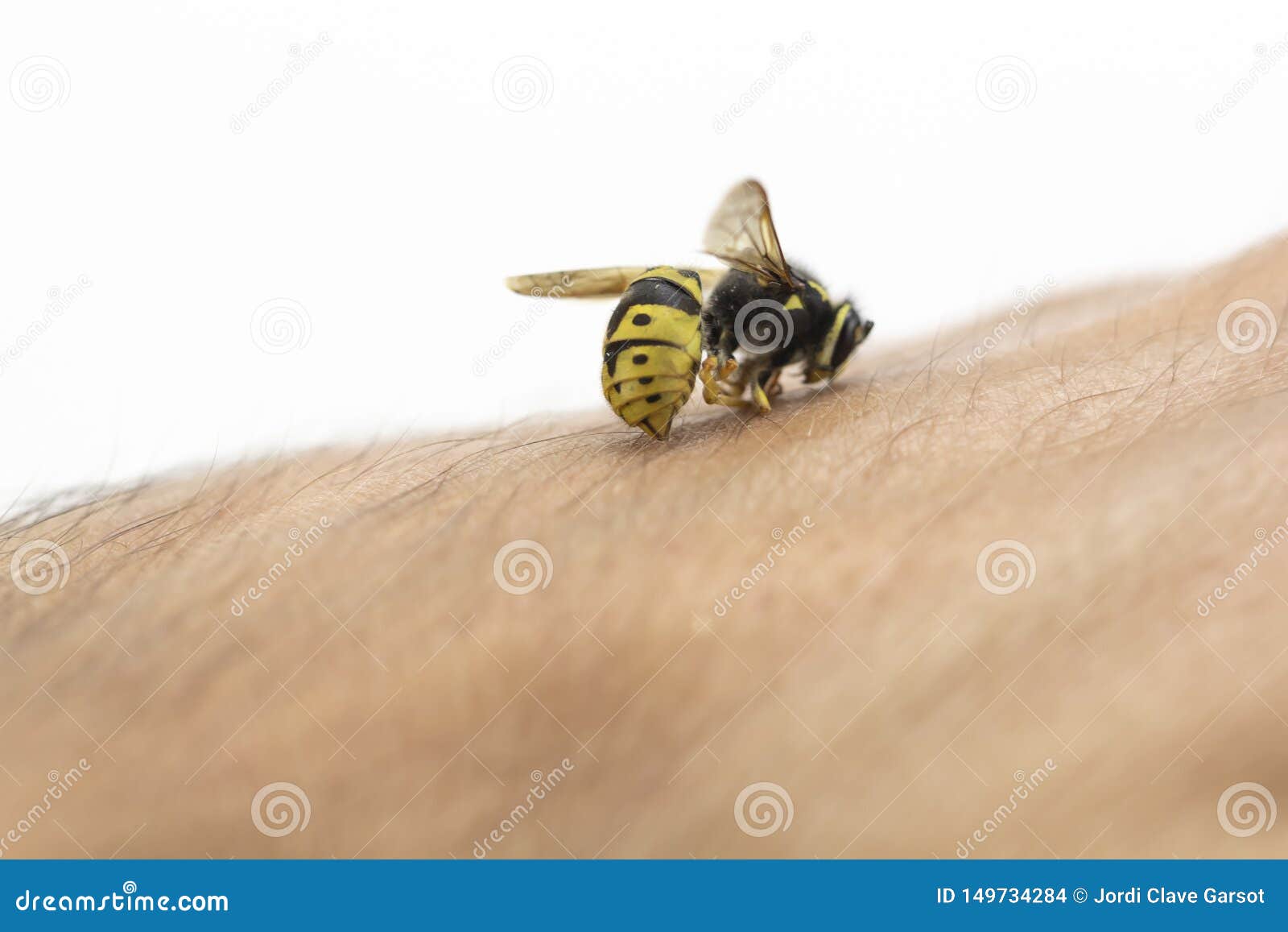 Bee stinging in human hand stock photo. Image of insect 149734284