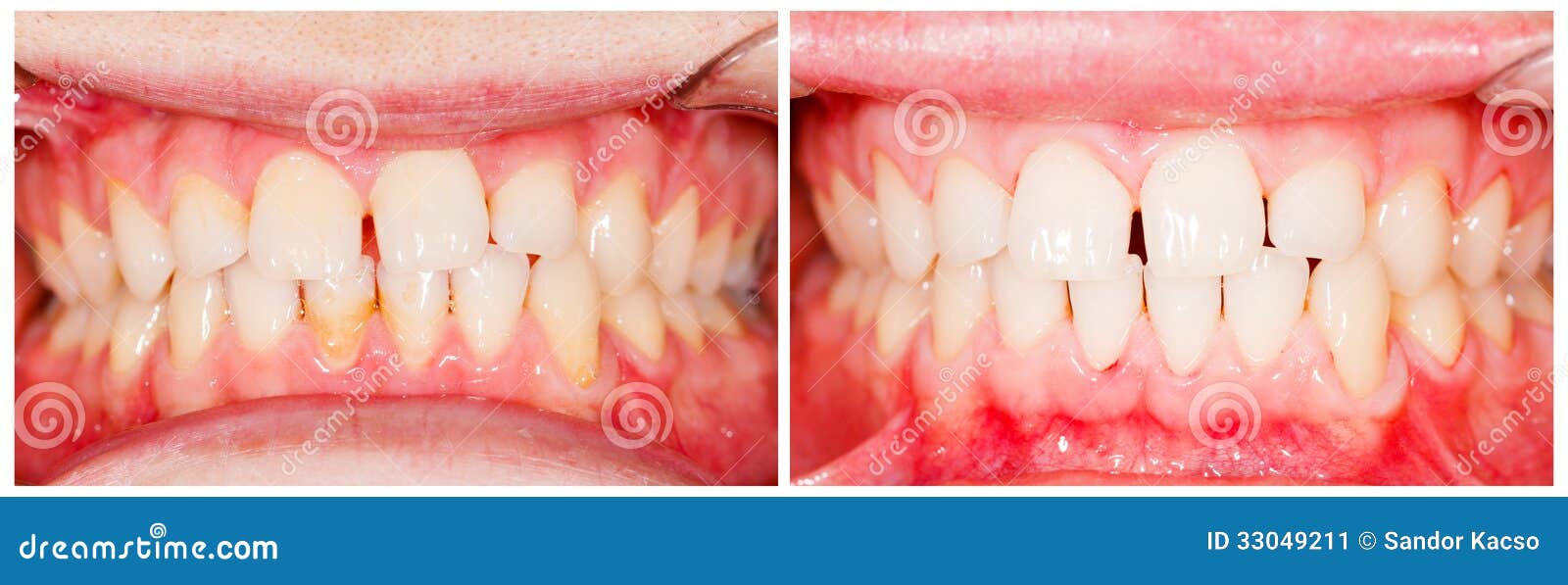 Before and after Plaque Removal Stock Image Image of whitening
