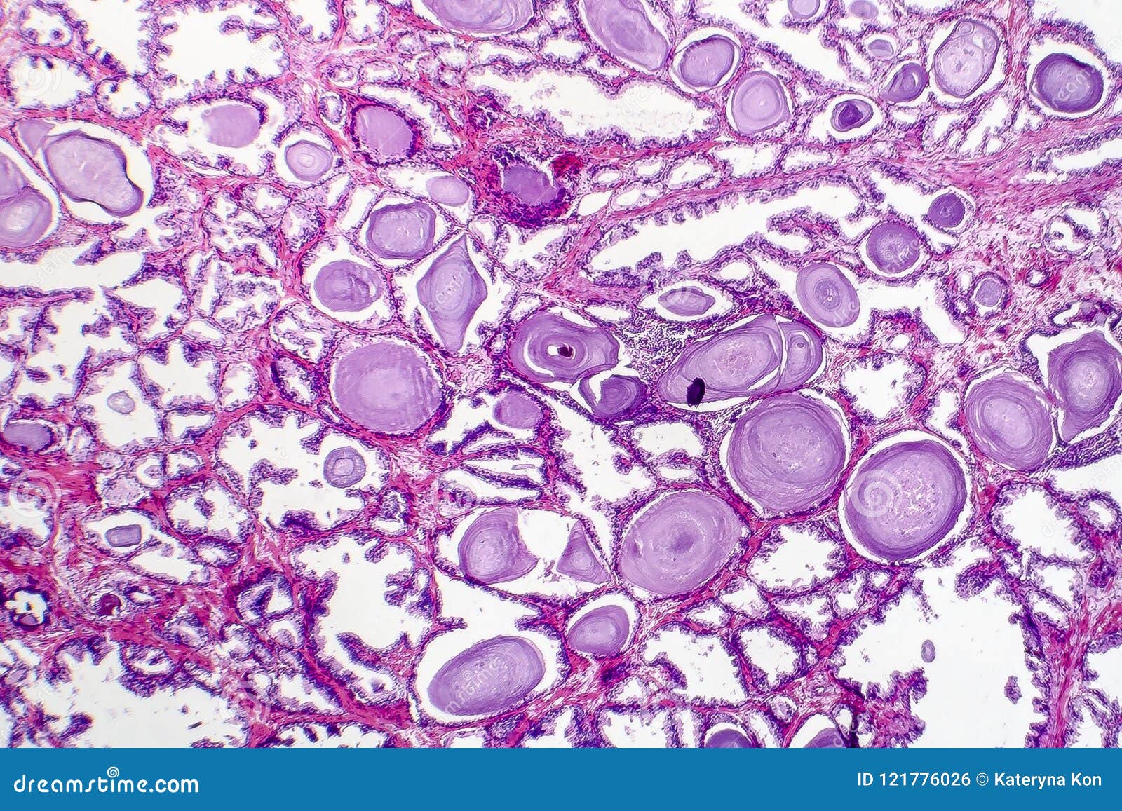 benign prostatic hyperplasia