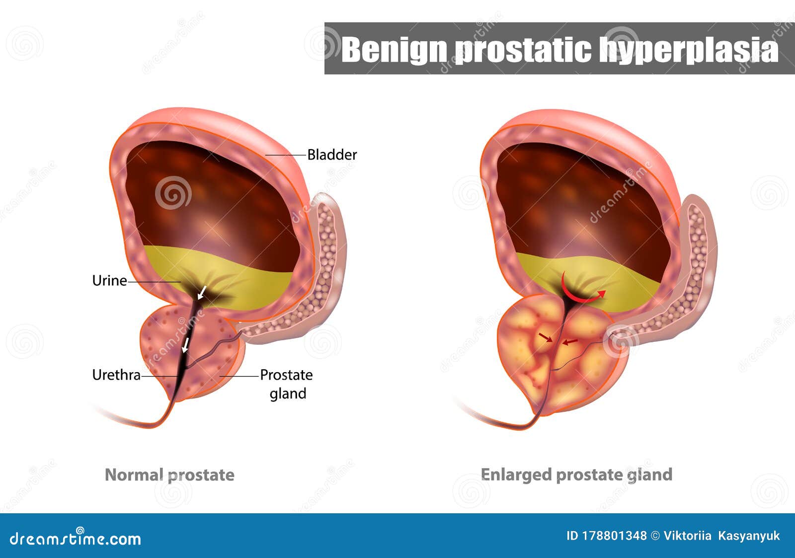 benign prostatic hyperplasia( bph))