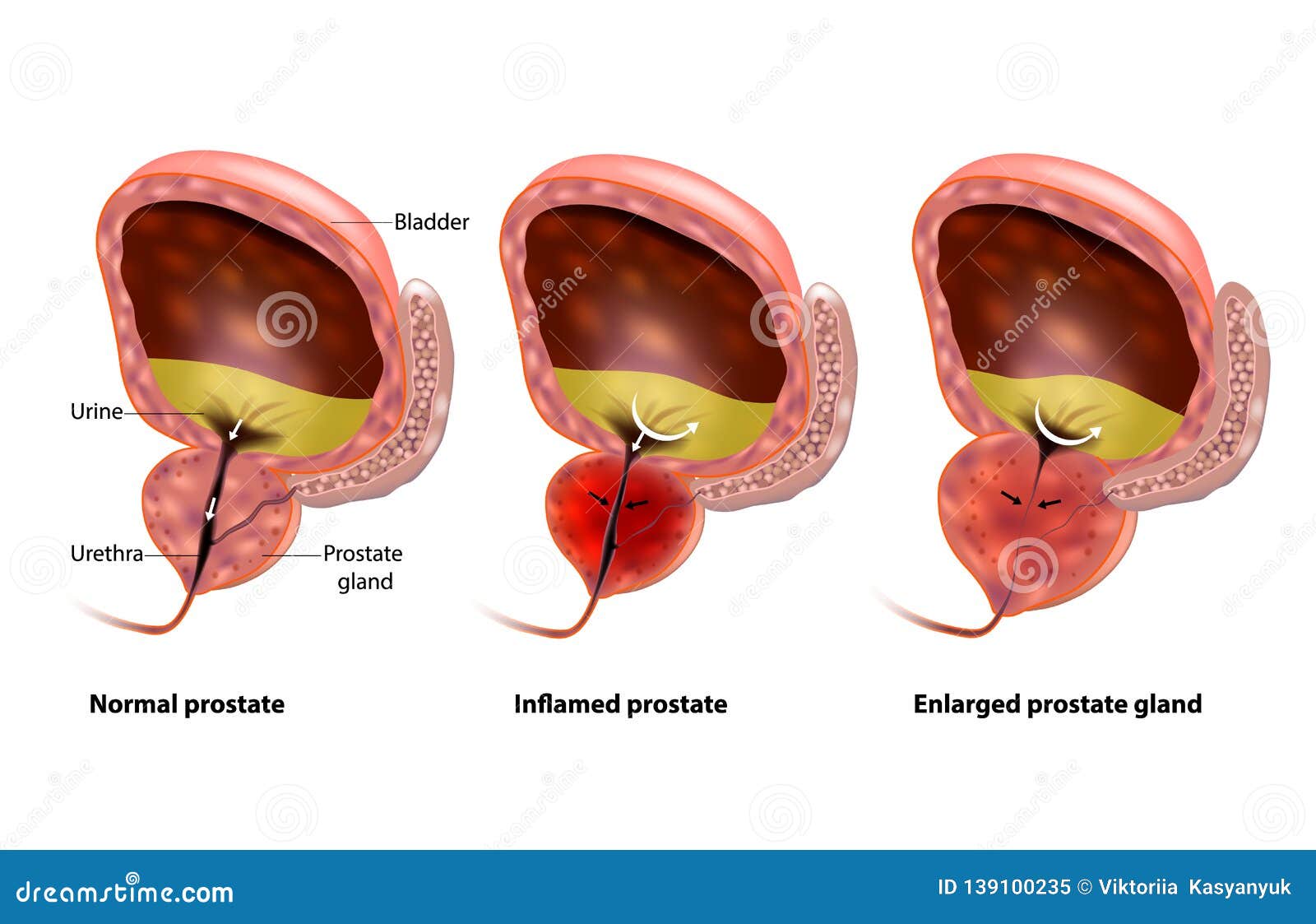 enlarged prostate at 24