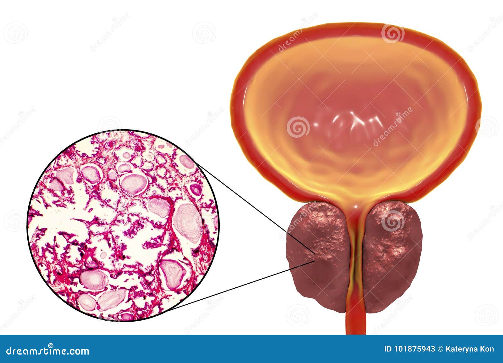 benign prostatic hyperplasia