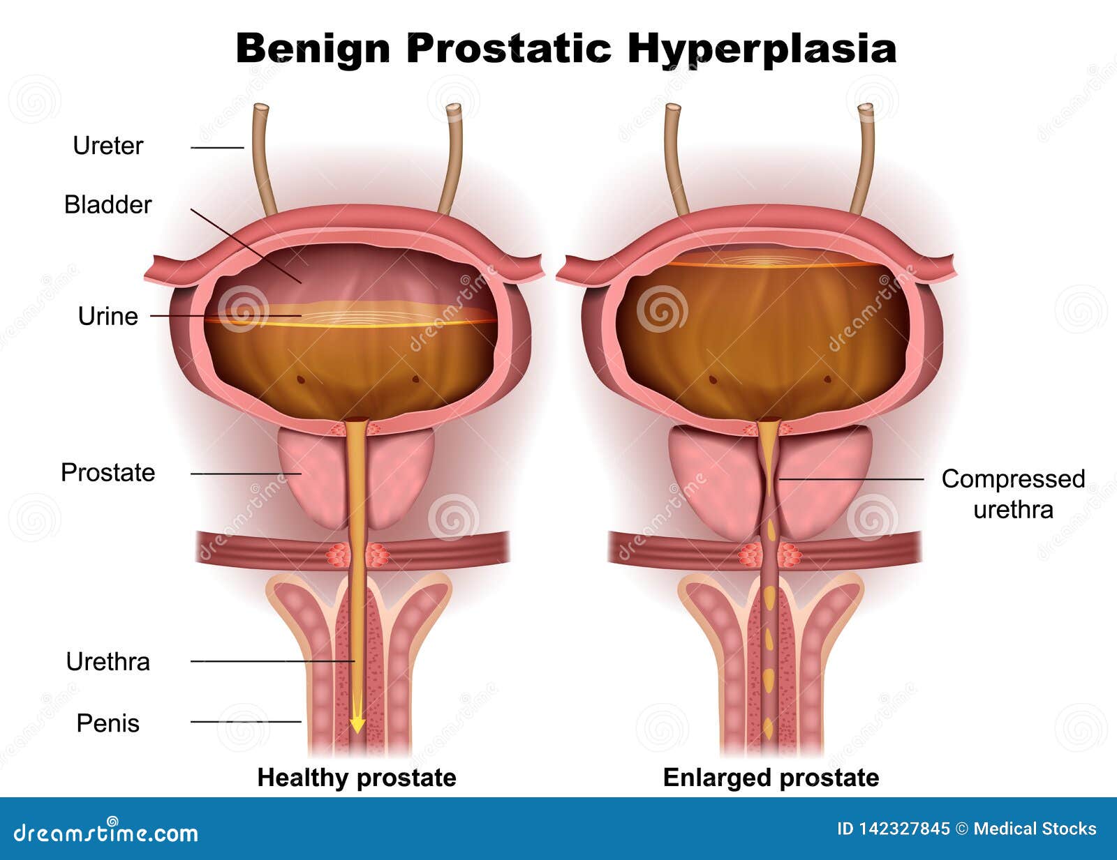 méretek hyperplasia prostate mi az