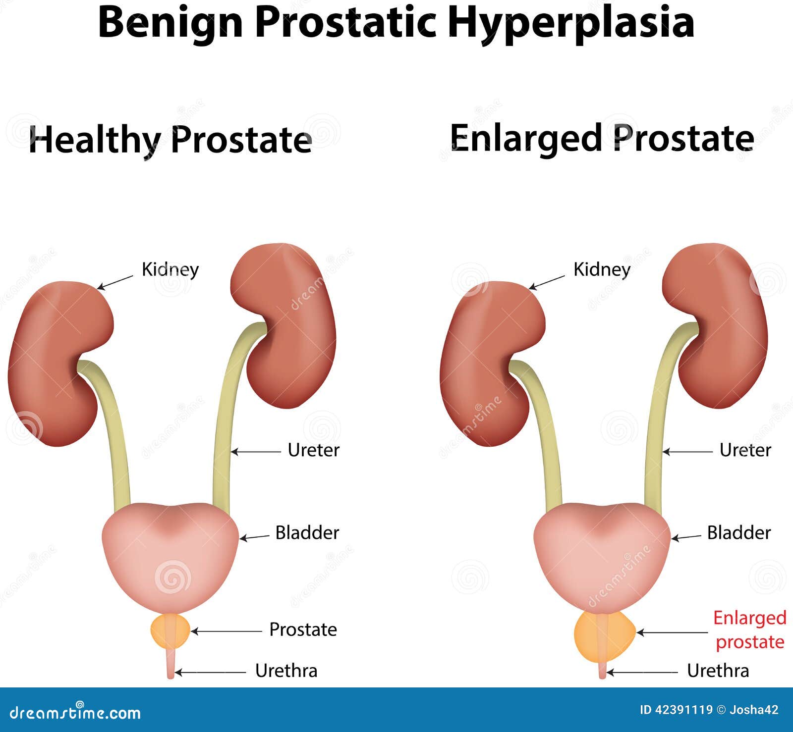 prostate equity hyperplasia