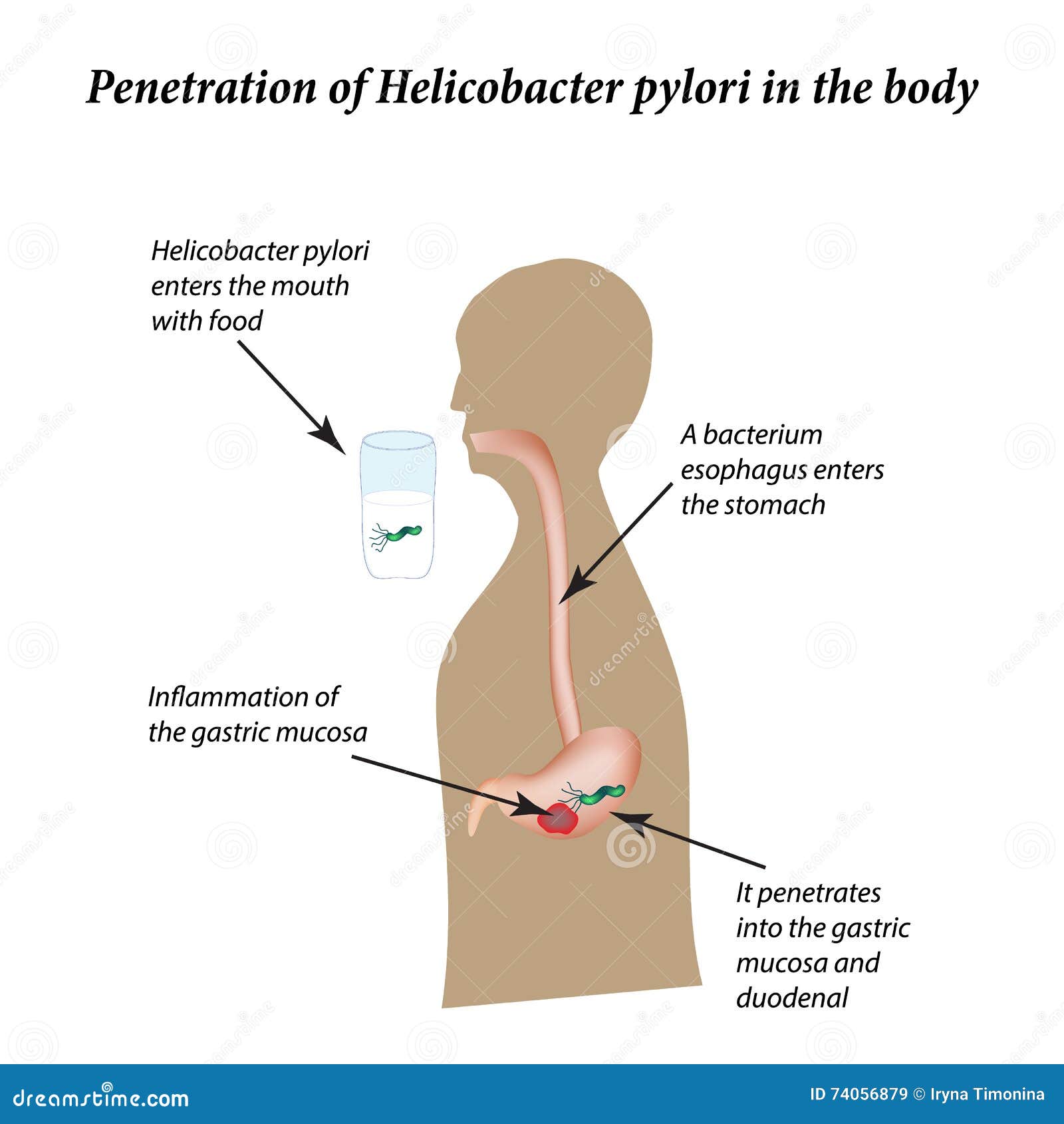 Besmetting Met Helicobacterpylori Infographics Vector Illustratie