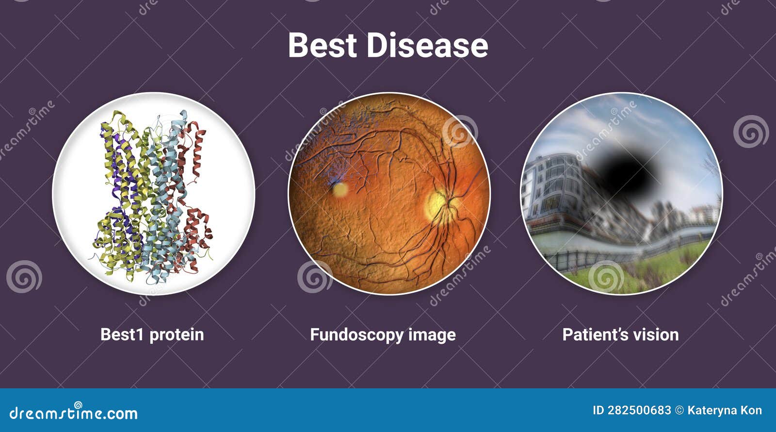 best disease. best vitelliform macular dystrophy, 