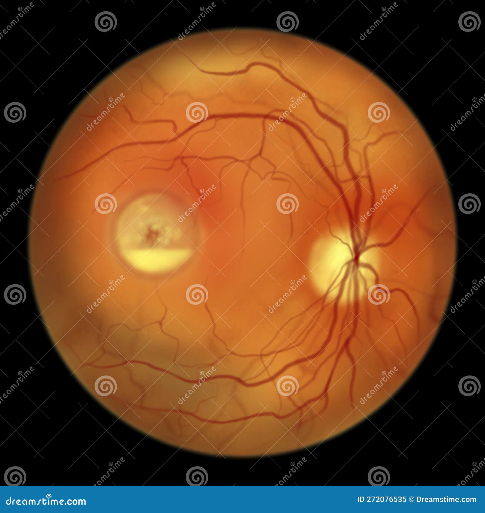 Best Vitelliform Macular Dystrophy, Pseudohypopyon Stage, Layering of