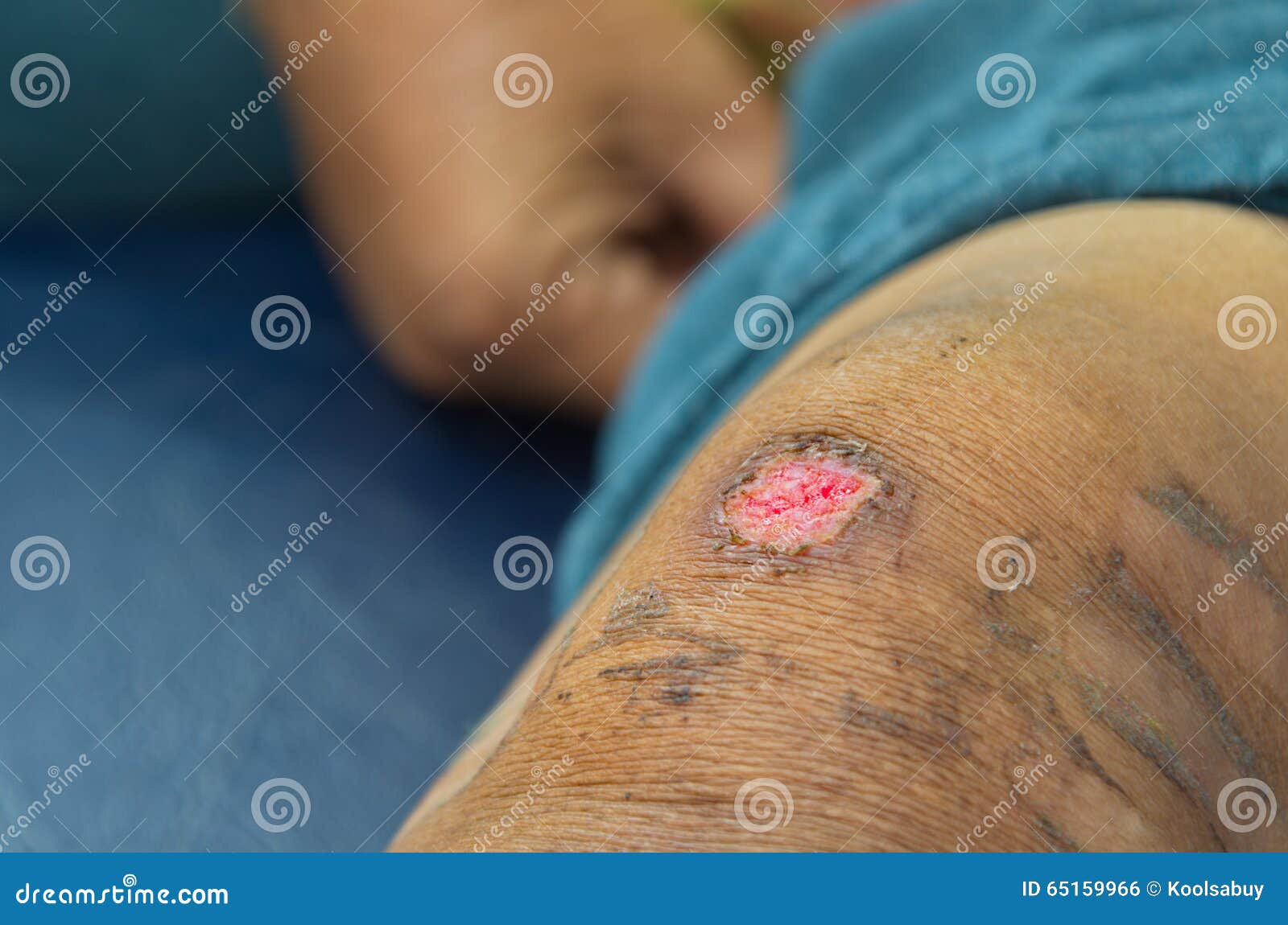 Bicycle accident wound. stock photo. Image of medical 65159966