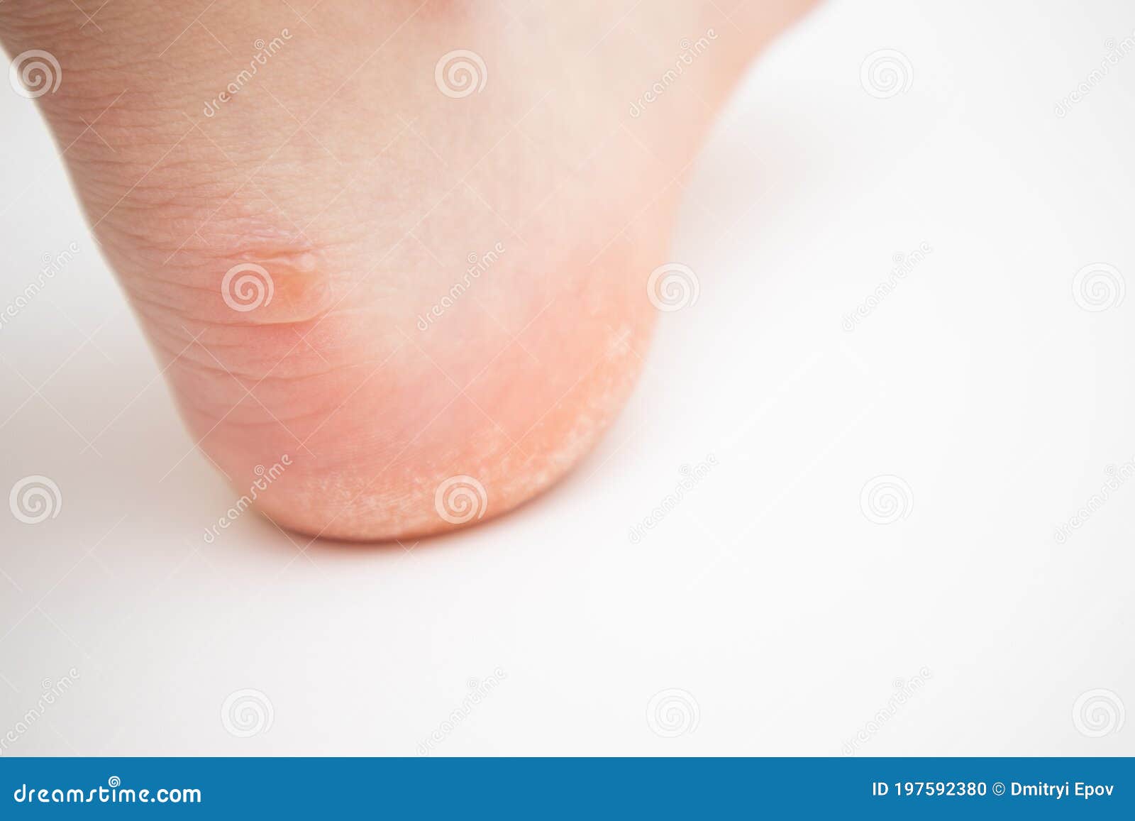Big Callus on Heel. Feet with Callus of Dead Skin. Stock Photo Image