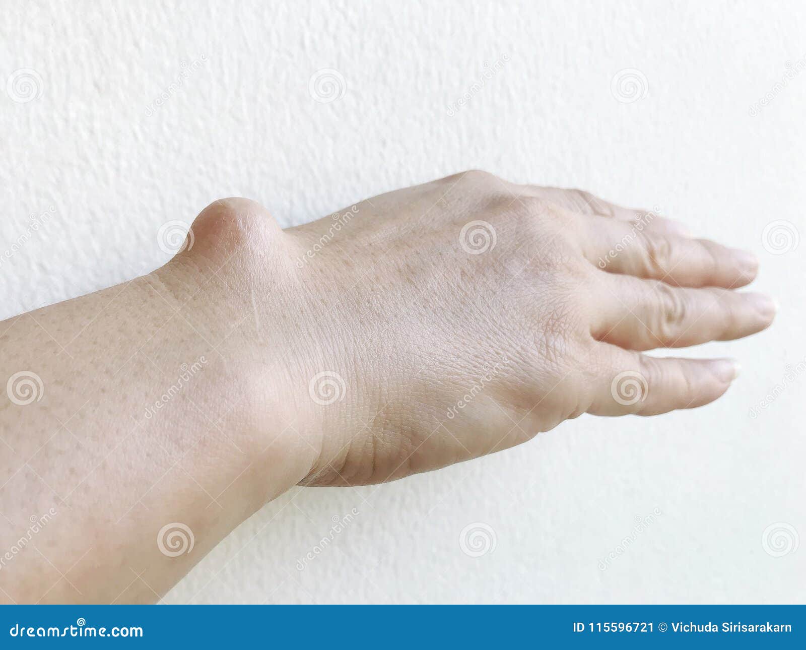 lump on top of wrist