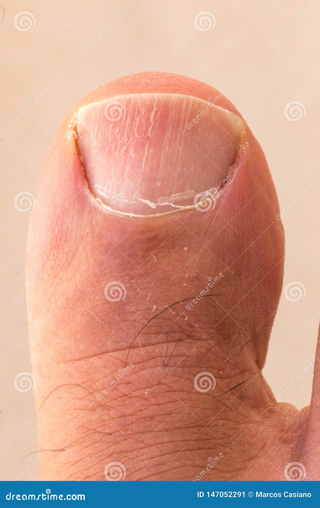 big toe dry skin cracking