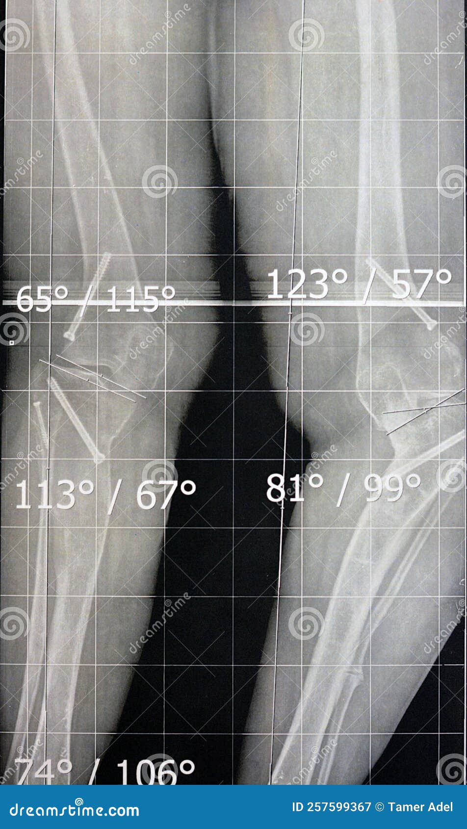 bilateral metaphyseal genu varum, previous epiphysiodesis, left distal femur valgus and left medial tibial plateau depression