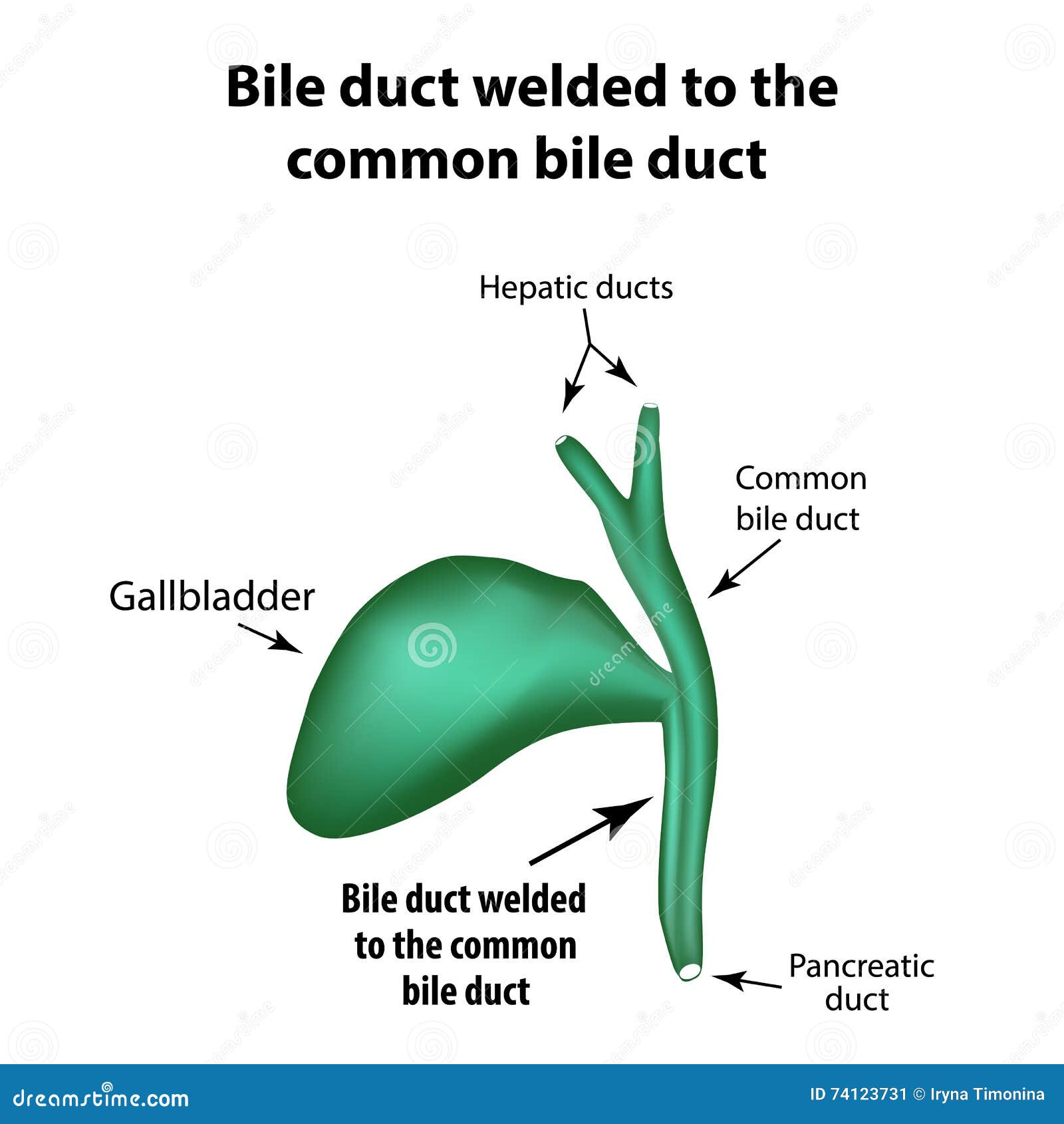 Enlarged Bile Duct