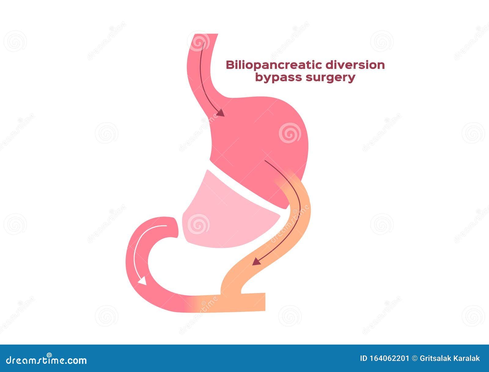 biliopancreatic diversion bypass surgery 