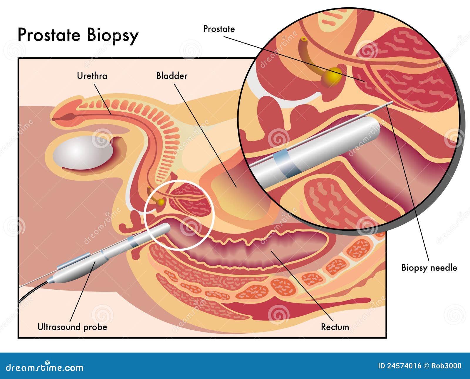 biopsia de próstata precio perú