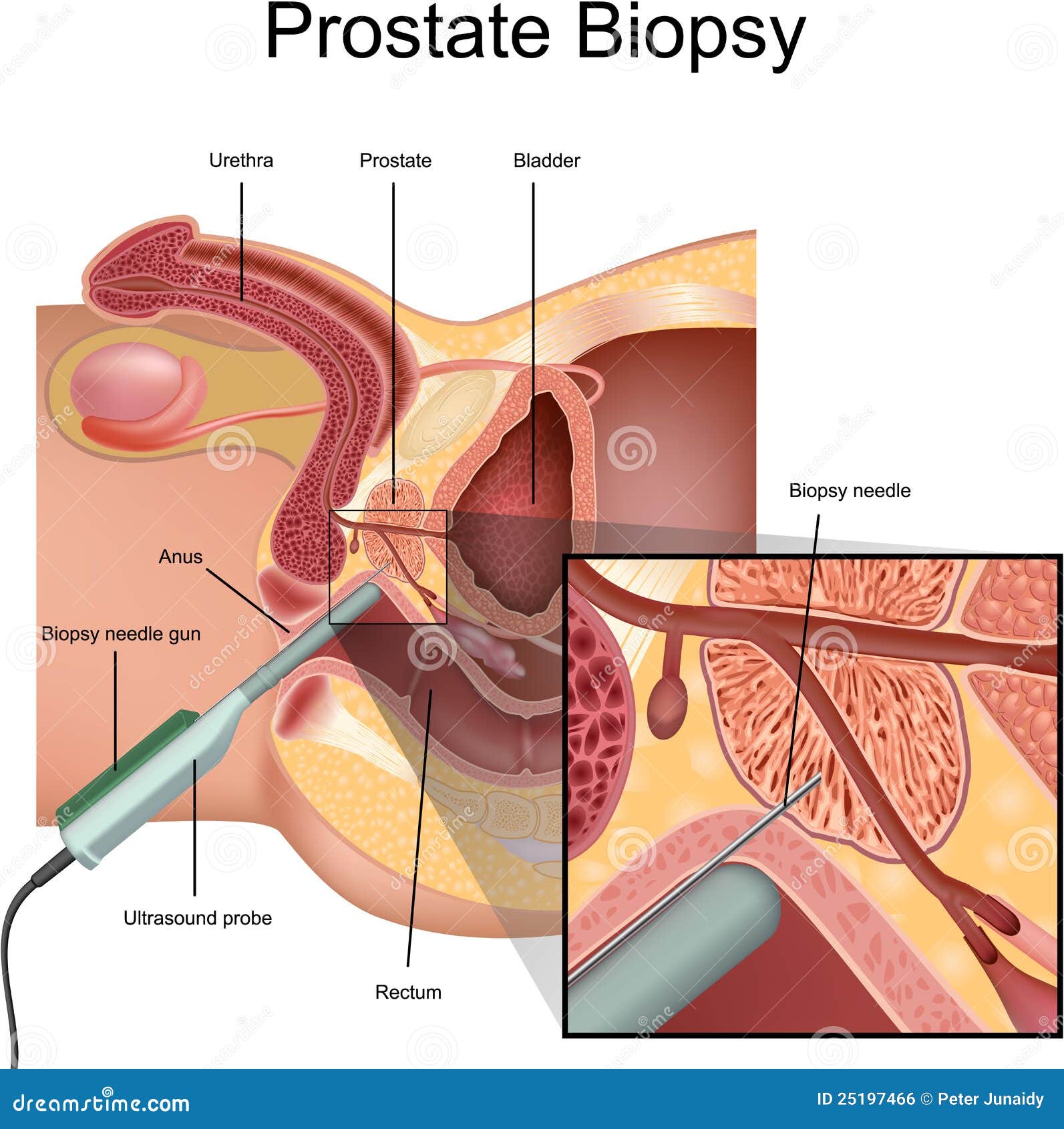 biopsia próstata)