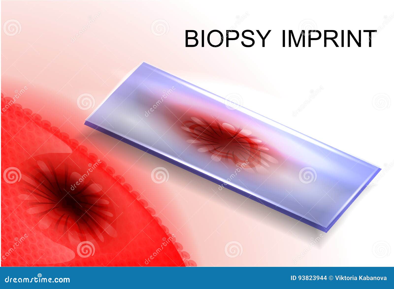Biopsy Imprint.diagnosis of Cancer Stock Vector Illustration of