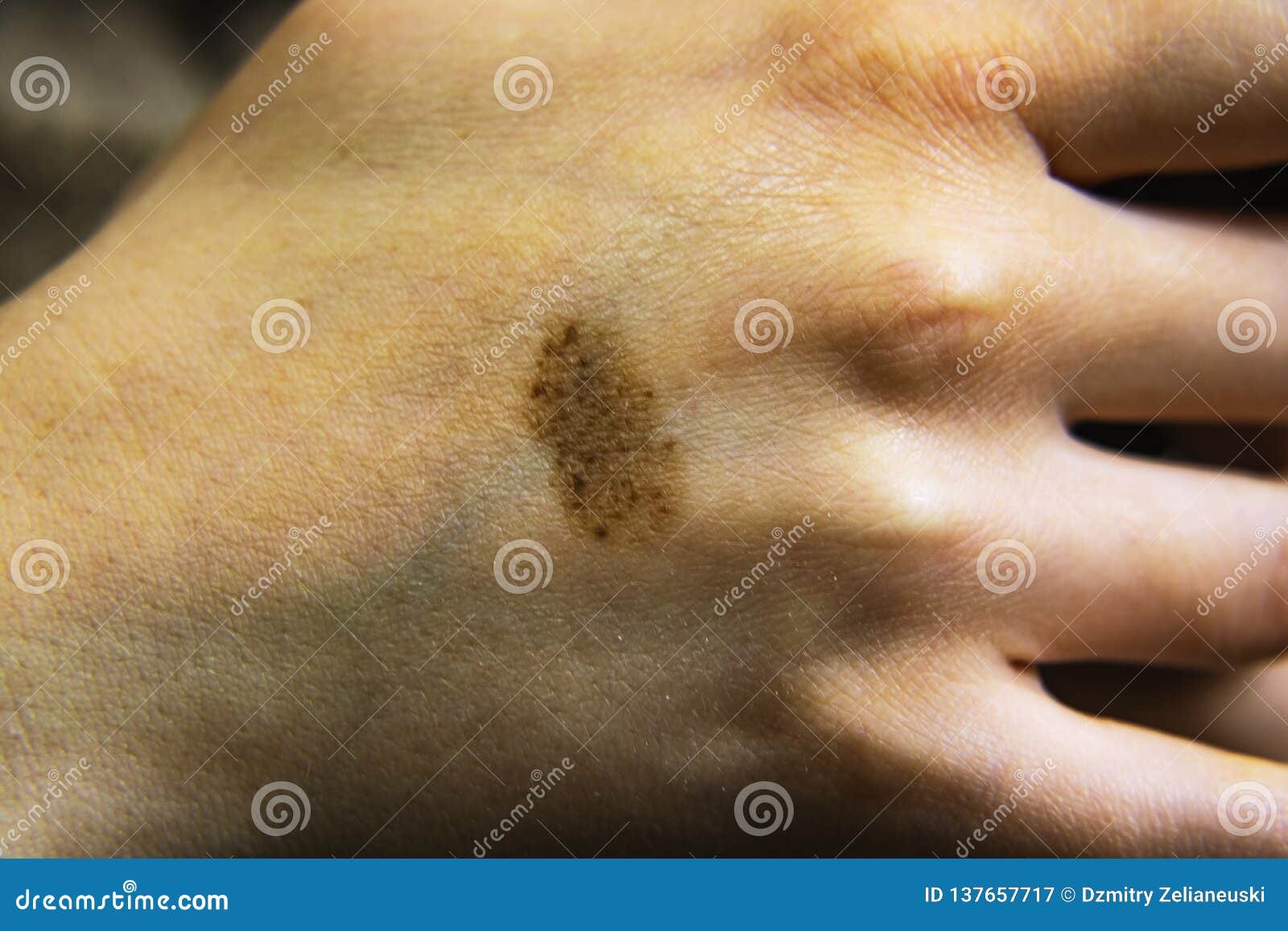 Birthmark Or Mole On The Skin Of The Hand Can Be Used For The Concept